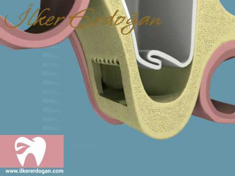 Sinus Lift with Implant Placement Movie
